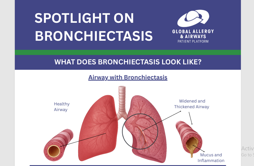 Spotlight on Bronchiectasis